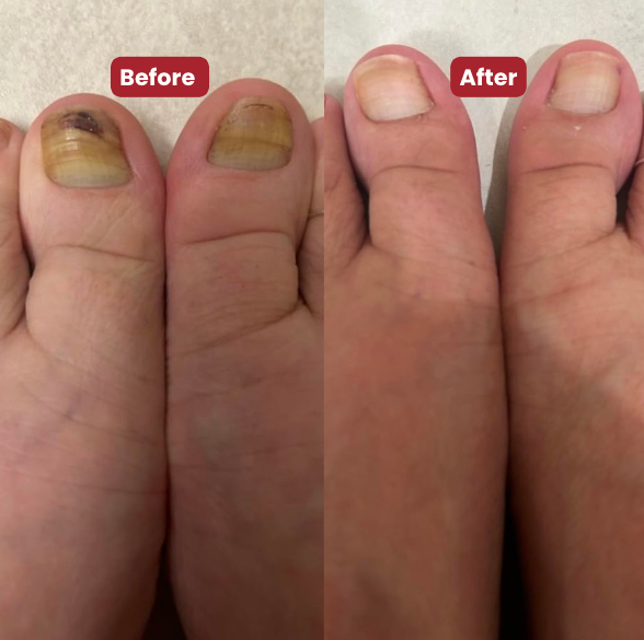NEW Nailo™ 2.0 : get healthy, smooth, and clear toenails in 14 days.