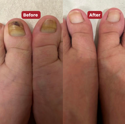NEW Nailo™ 2.0 : get healthy, smooth, and clear toenails in 14 days.