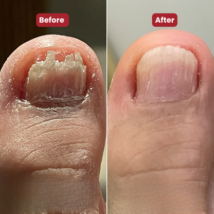 NEW Nailo™ 2.0 : get healthy, smooth, and clear toenails in 14 days.