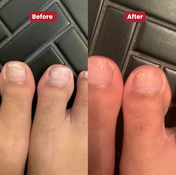 NEW Nailo™ 2.0 : get healthy, smooth, and clear toenails in 14 days.