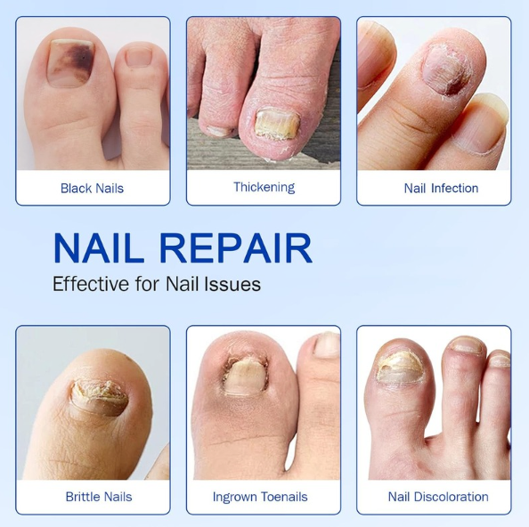 NEW Nailo™ 2.0 : get healthy, smooth, and clear toenails in 14 days.