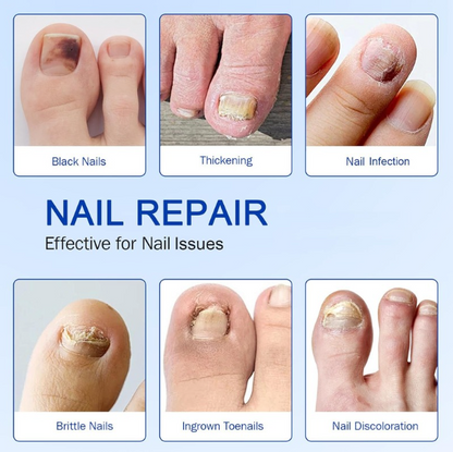 NEW Nailo™ 2.0 : get healthy, smooth, and clear toenails in 14 days.